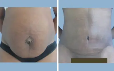Before and After